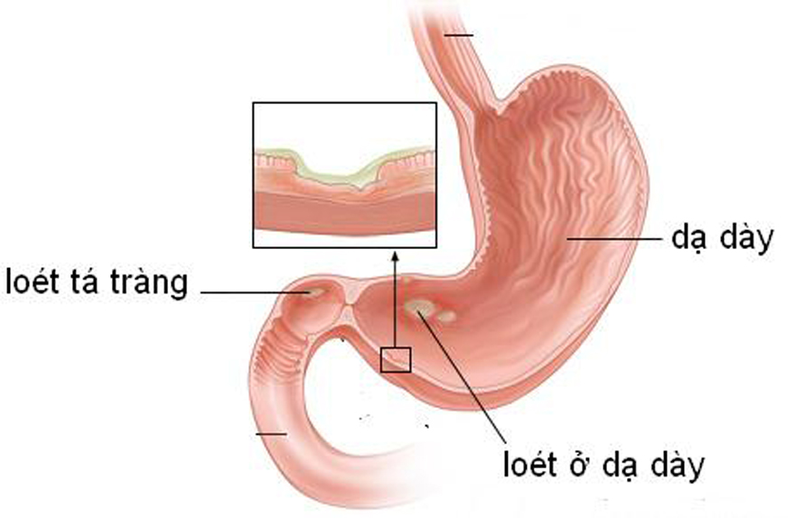 Các hiện tượng loét thường gặp ở đường ruột