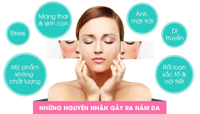 Mang thai, ánh mặt trời, mỹ phẩm, stress...v.v, có hàng ngàn nguyên nhân gây ra nám ở làn da của chị em