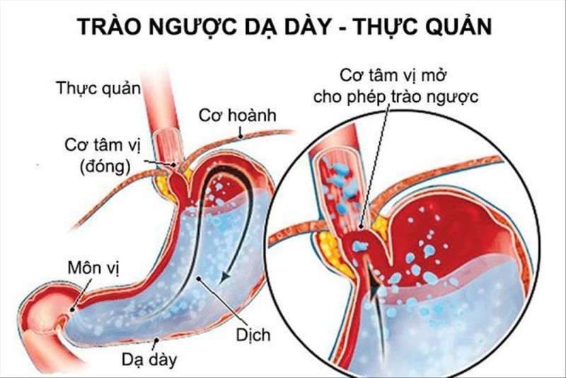 Trào ngược dạ dày gây ra chứng hôi miệng rất kinh khủng